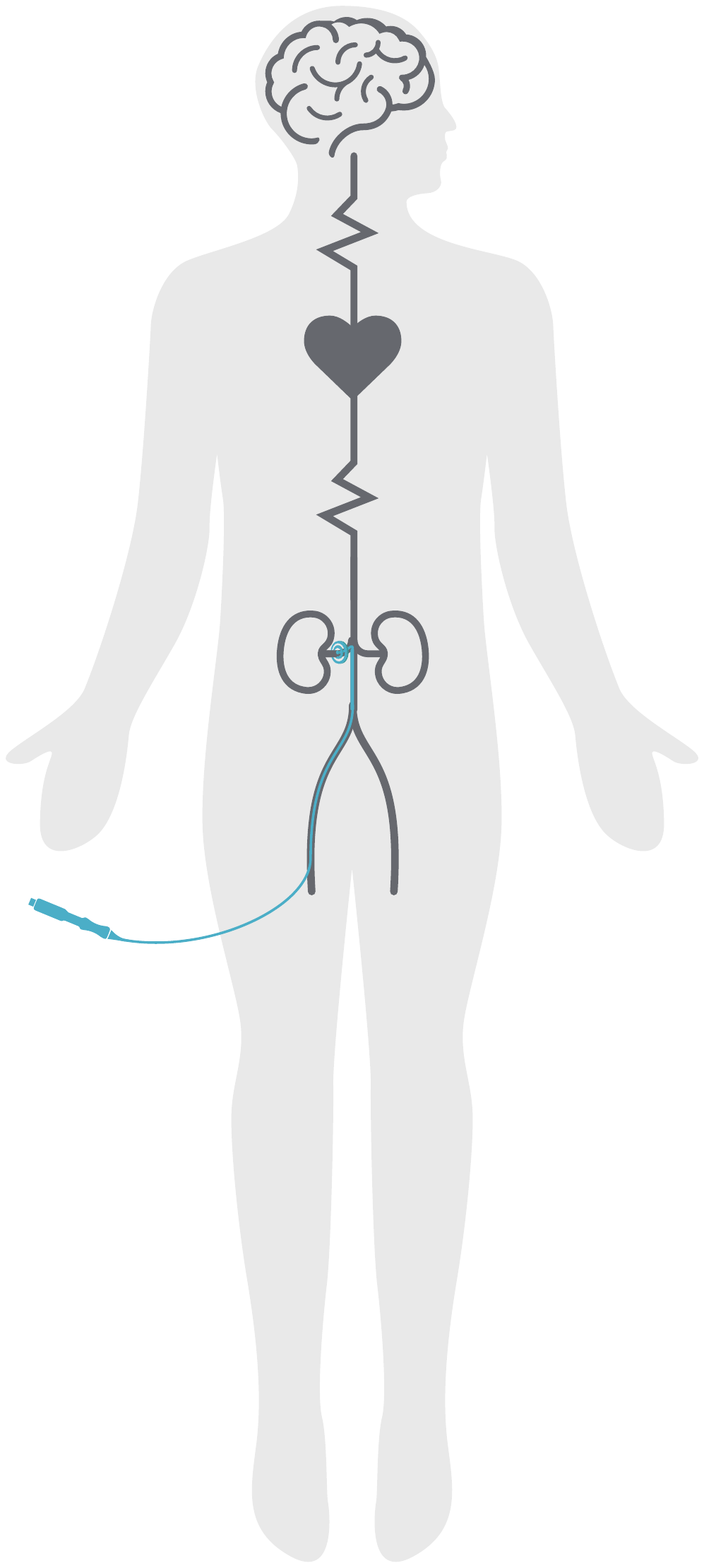 Diagram showing the brain, heart and kidneys connected by nerves, with a catheter approaching the renal artery